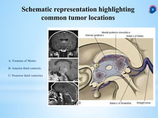 A: Foramen of Monro
B: Anterior third ventricle;
C: Posterior third ventricle)
Schematic representation highlighting
common tumor locations
 