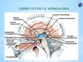 THIRD VENTICLE APPROACHES
 