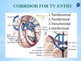 CORRIDOR FOR TV ENTRY
 