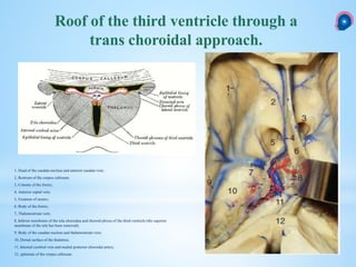 1, Head of the caudate nucleus and anterior caudate vein;
2, Rostrum of the corpus callosum;
3, Column of the fornix;
4, Anterior septal vein;
5, Foramen of monro;
6, Body of the fornix;
7, Thalamostriate vein;
8, Inferior membrane of the tela choroidea and choroid plexus of the third ventricle (the superior
membrane of the tela has been removed);
9, Body of the caudate nucleus and thalamostriate vein;
10, Dorsal surface of the thalamus;
11, Internal cerebral vein and medial posterior choroidal artery;
12, splenium of the corpus callosum.
Roof of the third ventricle through a
trans choroidal approach.
 