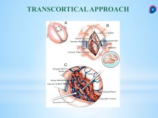 TRANSCORTICALAPPROACH
 