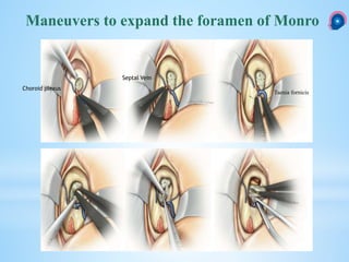 Maneuvers to expand the foramen of Monro
Choroid plexus
Septal Vein
Taenia fornicis
 