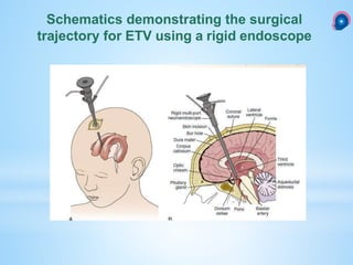Schematics demonstrating the surgical
trajectory for ETV using a rigid endoscope
 