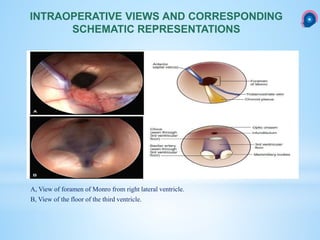 A, View of foramen of Monro from right lateral ventricle.
B, View of the floor of the third ventricle.
INTRAOPERATIVE VIEWS AND CORRESPONDING
SCHEMATIC REPRESENTATIONS
 