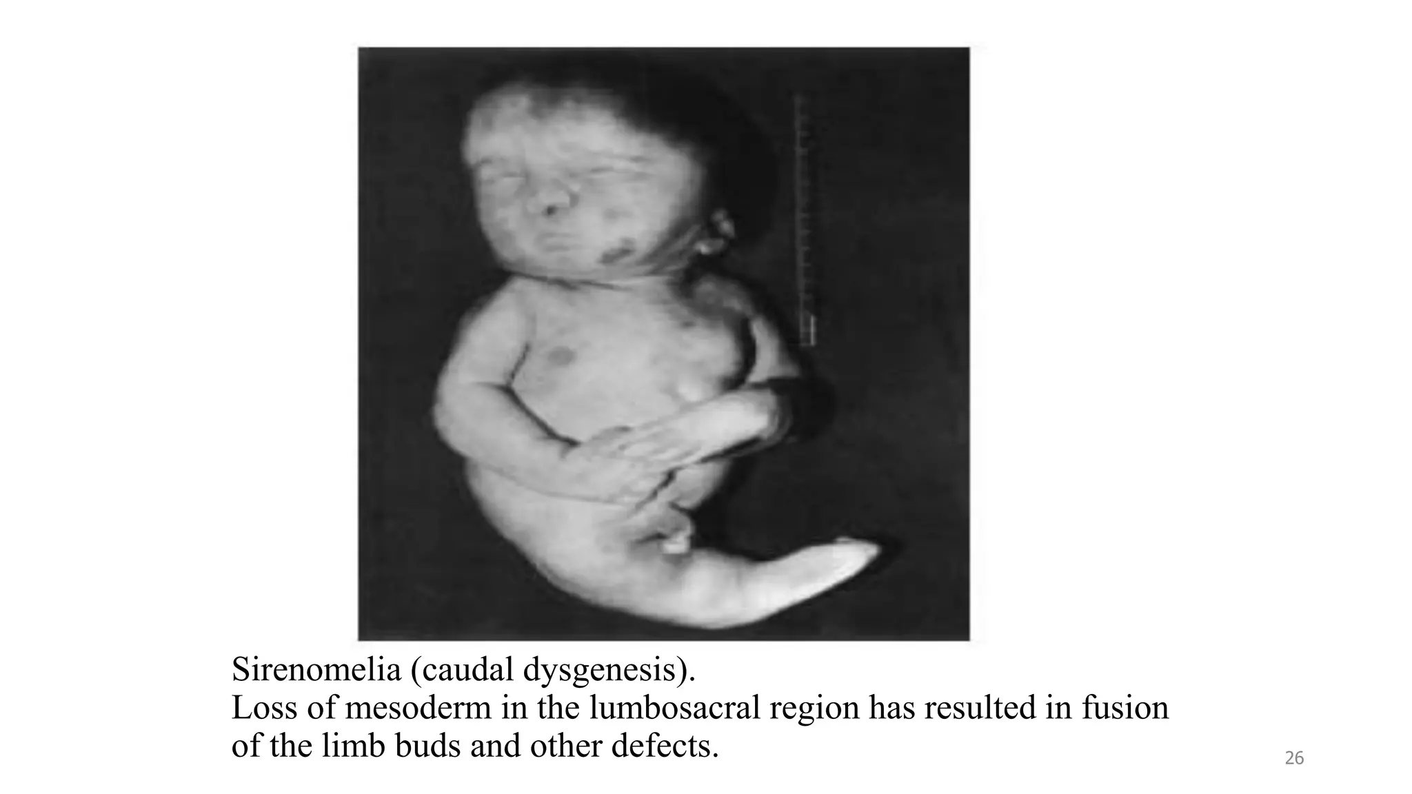 Sirenomelia (caudal dysgenesis).
Loss of mesoderm in the lumbosacral region has resulted in fusion
of the limb buds and other defects. 26
 