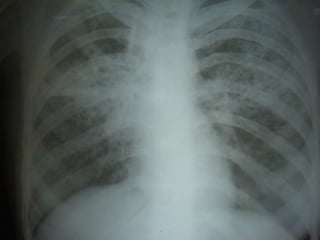 cxr