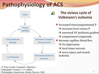 Compartment syndrome, acute, chronic, anatomy and operation | PPT