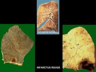 POUMON NORMAL




INFARCTUS ROUGE
 