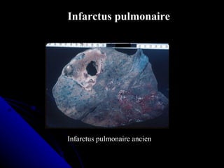 Infarctus pulmonaire




Infarctus pulmonaire ancien
 
