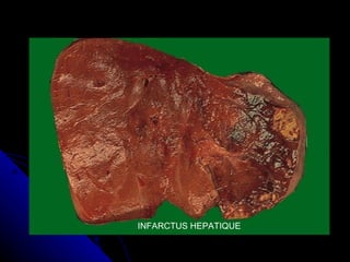 INFARCTUS HEPATIQUE
 