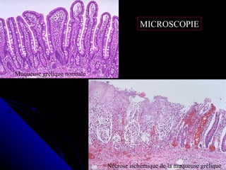 MICROSCOPIE




Muqueuse grêlique normale




                            Nécrose ischémique de la muqueuse grêlique
 