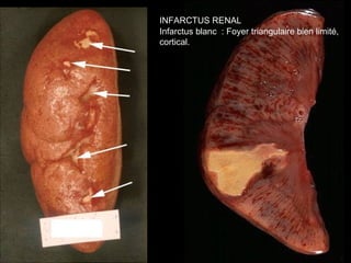 INFARCTUS RENAL
Infarctus blanc : Foyer triangulaire bien limité,
cortical.
 