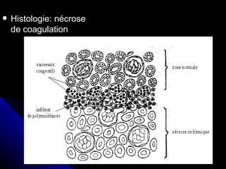    Histologie: nécrose
    de coagulation
 