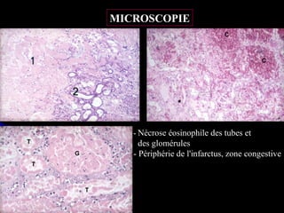 MICROSCOPIE




   - Nécrose éosinophile des tubes et
     des glomérules
   - Périphérie de l'infarctus, zone congestive
 