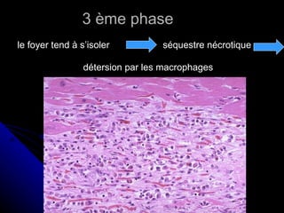 3 ème phase
le foyer tend à s’isoler          séquestre nécrotique

                 détersion par les macrophages
 