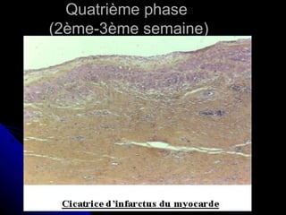 Quatrième phase
(2ème-3ème semaine)
 