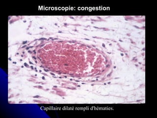 Microscopie: congestion




Capillaire dilaté rempli d'hématies.
 