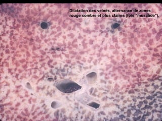 Dilatation des veines, alternance de zones
rouge sombre et plus claires (foie "muscade").
 