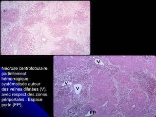 Nécrose centrolobulaire
partiellement
hémorragique,
systématisée autour
des veines dilatées (V),
avec respect des zones
périportales . Espace
porte (EP).
 