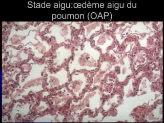 Stade aigu:œdème aigu du
     poumon (OAP)
 