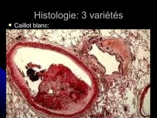 Histologie: 3 variétés
   Caillot blanc:
 