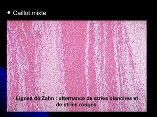    Caillot mixte




     Lignes de Zahn : alternance de stries blanches et
                    de stries rouges
 
