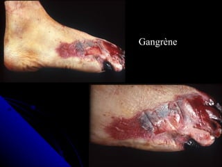 Gangrène
 
