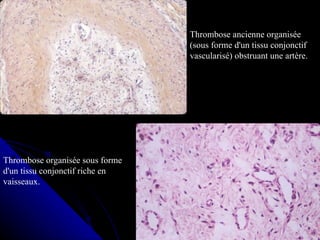 Thrombose ancienne organisée
                                 (sous forme d'un tissu conjonctif
                                 vascularisé) obstruant une artère.




Thrombose organisée sous forme
d'un tissu conjonctif riche en
vaisseaux.
 