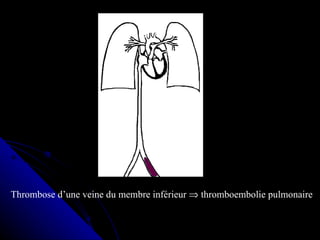 Thrombose d’une veine du membre inférieur ⇒ thromboembolie pulmonaire
 