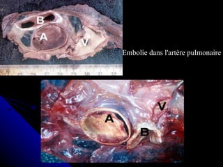 Embolie dans l'artère pulmonaire
 