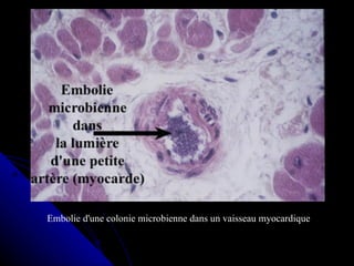 Embolie d'une colonie microbienne dans un vaisseau myocardique
 