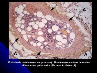 Embolie de moelle osseuse (poumon) : Moelle osseuse dans la lumière
           d'une artère pulmonaire (flèches). Alvéoles (A).
 