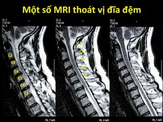 Một số MRI thoát vị đĩa ệm
T2W
L5-S1 disc
herniation
ti
o
n
h
er
ni
a
di
C2
C3
C4
C5
C6
C7
C2
C3
C4
C5
C6
 