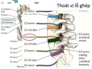 Thoát vị lỗ é
 