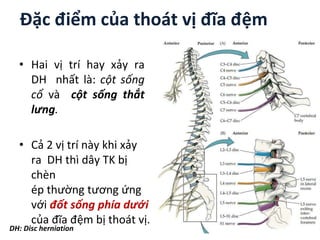 Đặc điểm của thoát vị đĩa ệm
• Hai vị trí hay xảy ra
DH nhất là: cột sống
cổ và cột sống thắt
lưng.
• Cả 2 vị trí này khi xảy
ra DH thì dây TK bị
chèn
ép thường tương ứng
với đốt sống phía dưới
của đĩa ệm bị thoát vị.
DH: Disc herniation
 