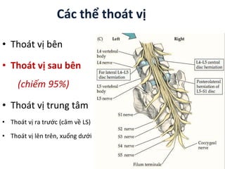 Các thể thoát vị
• Thoát vị bên
• Thoát vị sau bên
(chiếm 95%)
• Thoát vị trung tâm
• Thoát vị ra trước (câm về LS)
• Thoát vị lên trên, xuống dưới
 