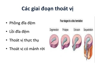 Các giai đoạn thoát vị
• Phồng đĩa ệm
• Lồi đĩa ệm
• Thoát vị thực thụ
• Thoát vị có mảnh rời
 