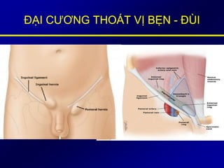 ĐẠI CƯƠNG THOÁT VỊ BẸN - ĐÙI
 