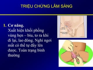 TRIỆU CHỨNG LÂM SÀNG
1. Cơ năng.
Xuất hiện khối phồng
vùng bẹn – bìu, to ra khi
đi lại, lao đông. Nghỉ ngơi
mất có thể tự đẩy lên
được. Toàn trạng bình
thường
 