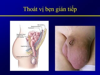 Thoát vị bẹn gián tiếp
 