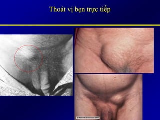 Thoát vị bẹn trực tiếp
 