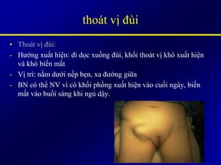 thoát vị đùi
• Thoát vị đùi:
- Hướng xuất hiện: đi dọc xuống đùi, khối thoát vị khó xuất hiện
và khó biến mất
- Vị trí: nằm dưới nếp bẹn, xa đường giữa
- BN có thể NV vì có khối phồng xuất hiện vào cuối ngày, biến
mất vào buổi sáng khi ngủ dậy.
 