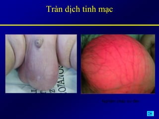 Tràn dịch tinh mạc
Nghiệm pháp soi đèn
 