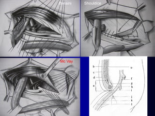 Bassini
Mc Vay
Shouldice
 