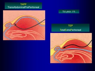 TAPP
TransAbdominalPrePeritoneal
TEP
TotalExtraPeritoneal
Taùi phaùt: 1%
 