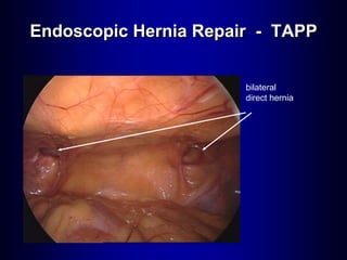 Endoscopic Hernia Repair - TAPP
bilateral
direct hernia
 