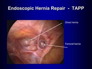 Direct hernia
Femoral hernia
Endoscopic Hernia Repair - TAPP
 