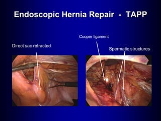 Direct sac retracted
Cooper ligament
Spermatic structures
Endoscopic Hernia Repair - TAPP
 