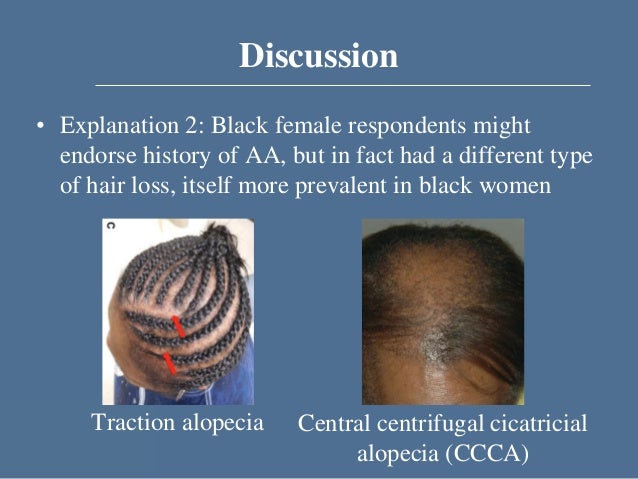 Prevalence of Alopecia Areata Differs by Race in Two Large Cohorts
