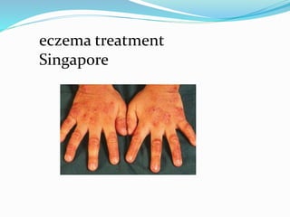 eczema treatment
Singapore